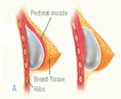 Breast Implant Placement: Over vs. Under the Muscle